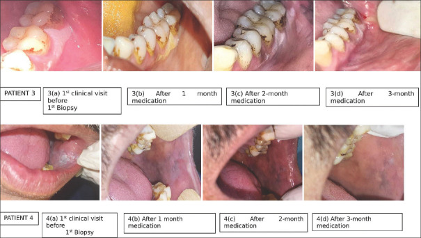 Assessment of clinical and histopathological changes in leukoplakia using curcumin lozenges based on revised WHO criteria- A pilot study.
