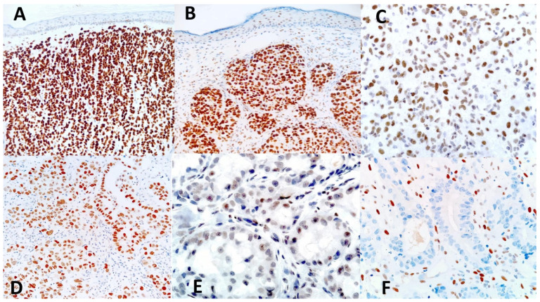 Expression of TRPS1 in Metastatic Tumors of the Skin: An Immunohistochemical Study of 72 Cases.