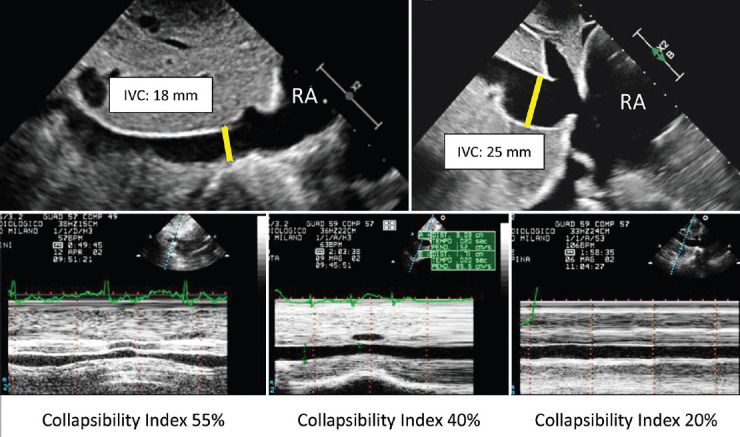 Noninvasive Estimation of Right Atrial, Right Ventricular, and Pulmonary Systolic Pressure: "A Good Story Never Ends".