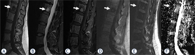 Assessment of chemical-shift and diffusion-weighted magnetic resonance imaging in differentiating malignant and benign vertebral lesions in oncologic patients. A single institution experience.