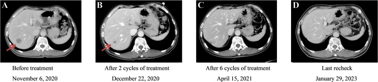 Sequential Autologous CIK/NK Cells Combined with Chemotherapy to Induce Long-Term Tumor Control in Advanced Rectal Cancer: A Case Report.