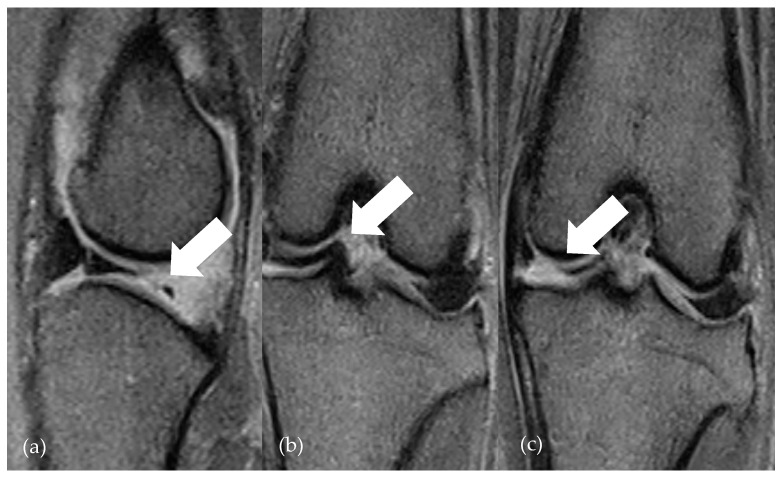 Low-Field Magnetic Resonance Imaging for the Detection of Medial Meniscal Lesions in Cranial Cruciate-Deficient Stifle Joints in Dogs.