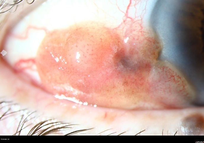 A Case of Conjunctival Melanoma Presenting as a Squamous Cell Carcinoma.