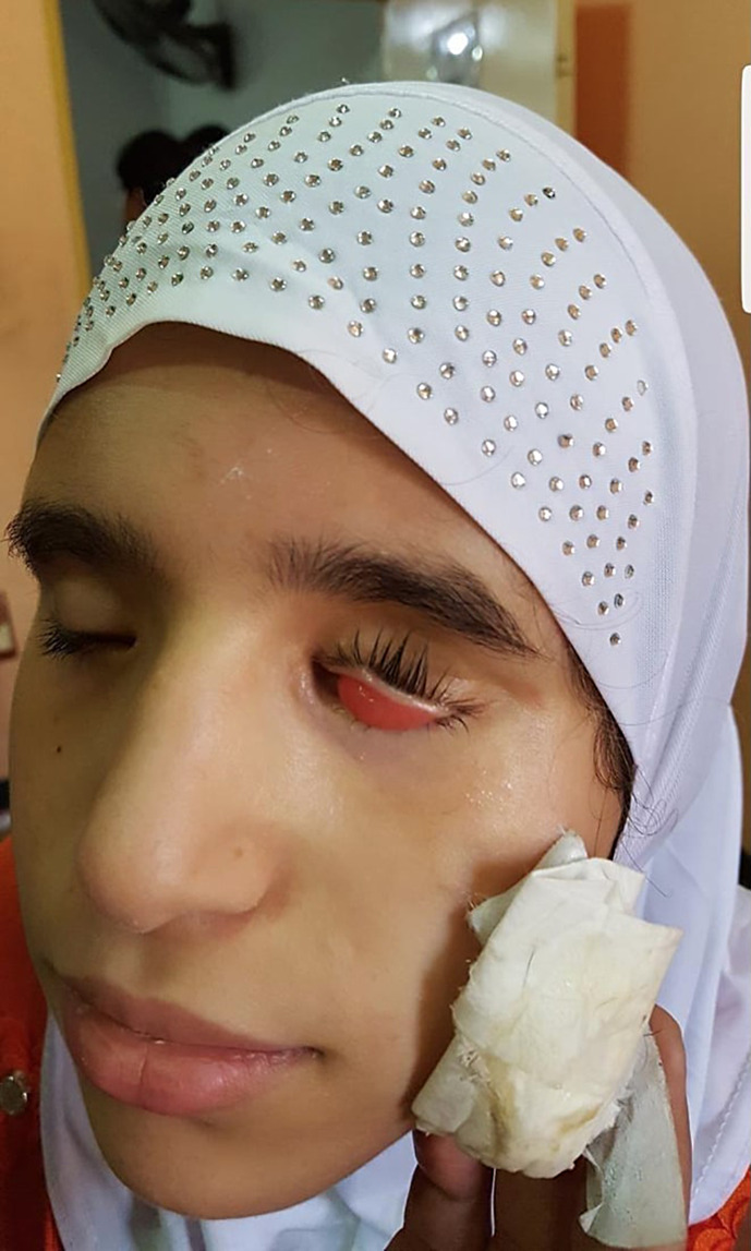 An Unexpected Response of Orbital Retinoblastoma to Inconsistent Systemic Chemotherapy Alone.