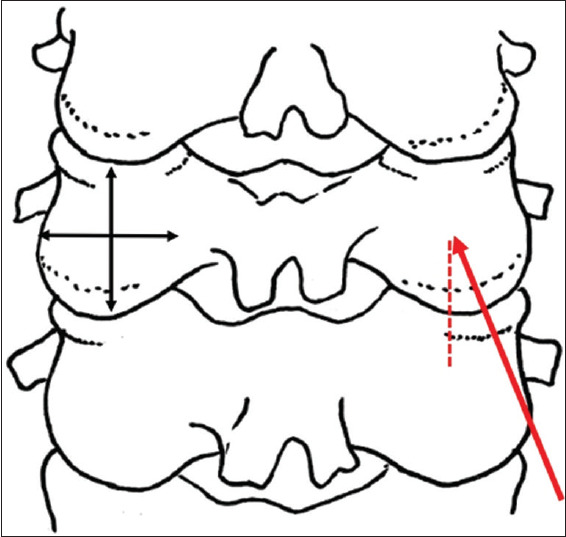 Lateral mass intrapedicular screw fixation: A radiological evaluation of screw pullout strength.