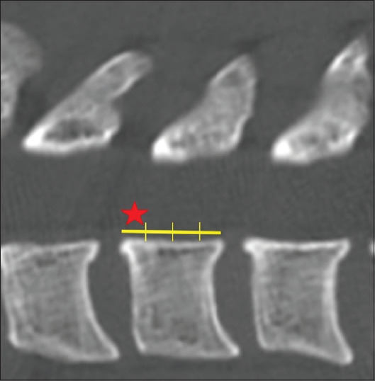 Lateral mass intrapedicular screw fixation: A radiological evaluation of screw pullout strength.
