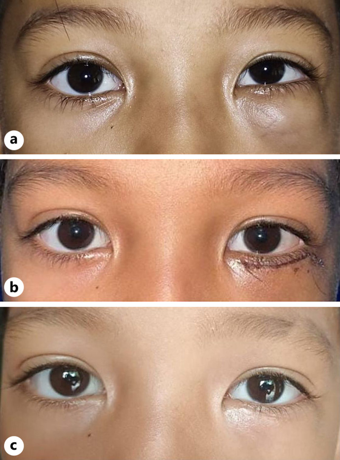 Wide-Excision Choice in Orbital Rhabdomyosarcoma on an 8-Year-Old Patient in a Low-Resource Setting: A Case Report.