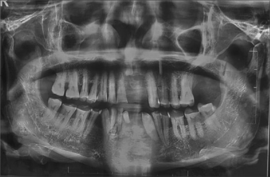 Osteochondroma of the anterior mandible: A rare case report and review of the literature.