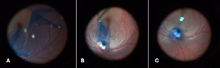Multilayered Inverted Internal Limiting Membrane Flap Technique in Optic Disc Pit Maculopathy.