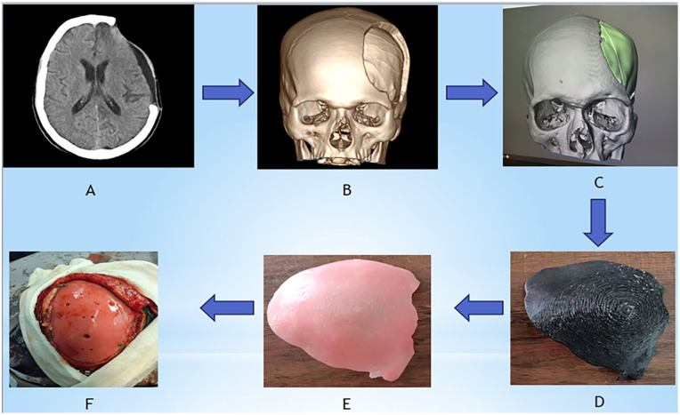 Cranial Defect Repair With 3D Designed Models.