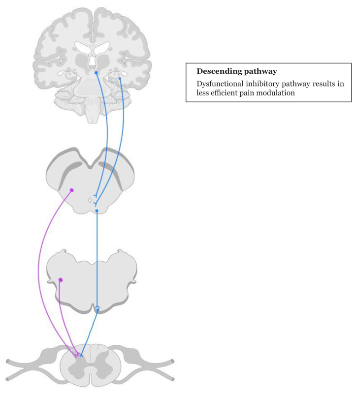 Lhermitte's Sign--A Neuropathic Pain and Its Neuroanatomy.