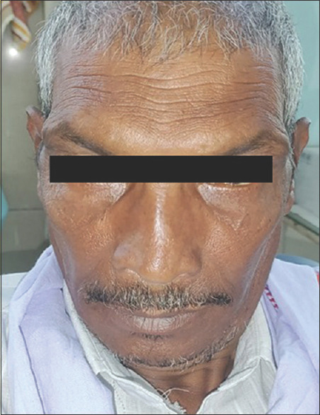 Osteochondroma of the anterior mandible: A rare case report and review of the literature.