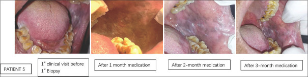 Assessment of clinical and histopathological changes in leukoplakia using curcumin lozenges based on revised WHO criteria- A pilot study.