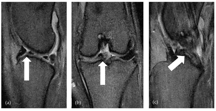 Low-Field Magnetic Resonance Imaging for the Detection of Medial Meniscal Lesions in Cranial Cruciate-Deficient Stifle Joints in Dogs.