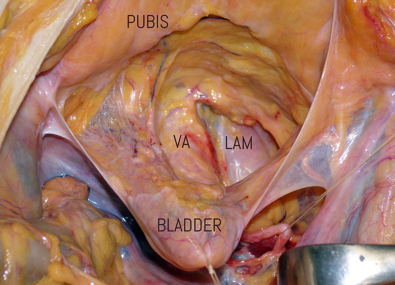 Extrauterine Causes of Severe and Concealed Postpartum Bleeding: Clinical Aspects and Challenges.