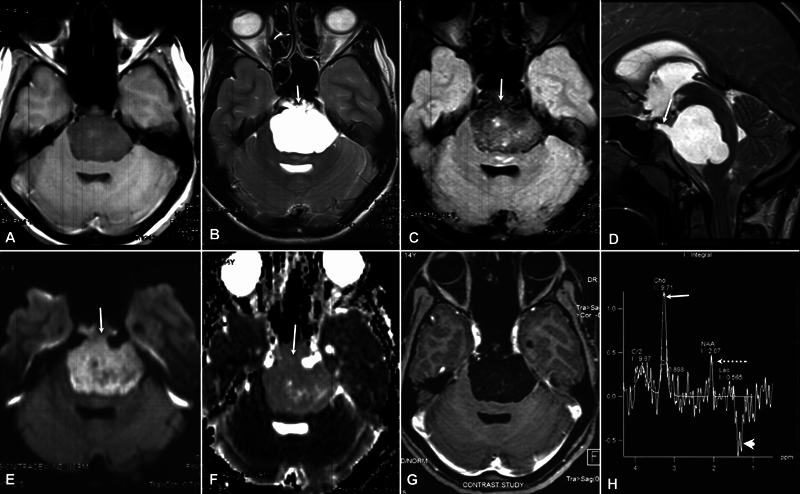 Nonenhancing Prepontine Chordoma with Diffusion Restriction Mimicking an Epidermoid Cyst.