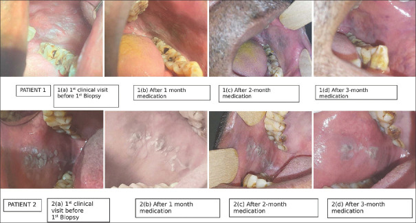 Assessment of clinical and histopathological changes in leukoplakia using curcumin lozenges based on revised WHO criteria- A pilot study.