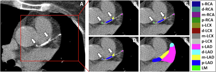 Automated segment-level coronary artery calcium scoring on non-contrast CT: a multi-task deep-learning approach.