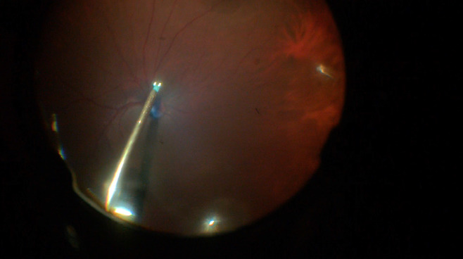 Multilayered Inverted Internal Limiting Membrane Flap Technique in Optic Disc Pit Maculopathy.