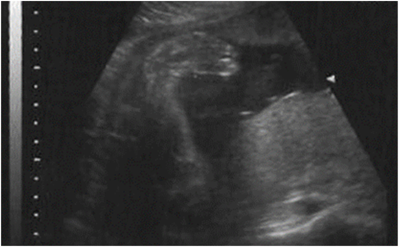 Prenatal Counseling for Congenital Clubfoot.