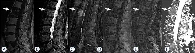 Assessment of chemical-shift and diffusion-weighted magnetic resonance imaging in differentiating malignant and benign vertebral lesions in oncologic patients. A single institution experience.