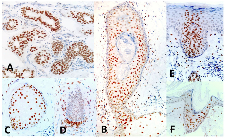 Expression of TRPS1 in Metastatic Tumors of the Skin: An Immunohistochemical Study of 72 Cases.