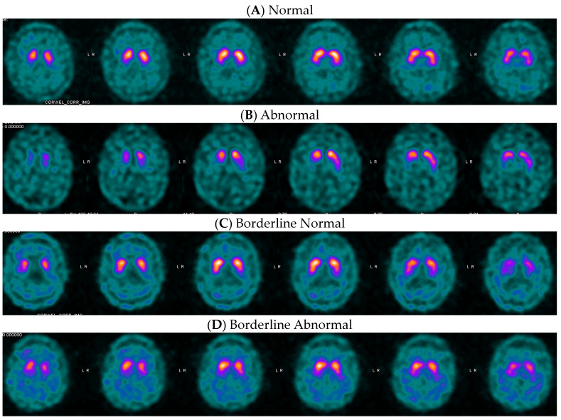 Optimal DaTQUANT Thresholds for Diagnostic Accuracy of Dementia with Lewy Bodies (DLB) and Parkinson's Disease (PD).