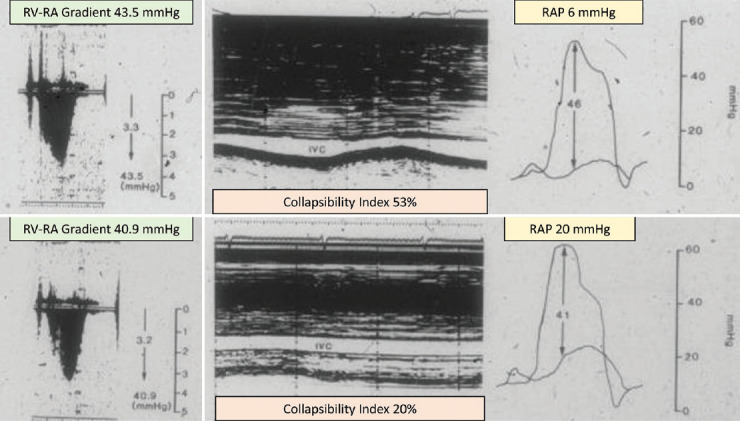 Noninvasive Estimation of Right Atrial, Right Ventricular, and Pulmonary Systolic Pressure: "A Good Story Never Ends".
