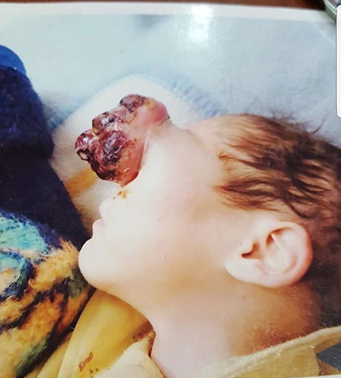 An Unexpected Response of Orbital Retinoblastoma to Inconsistent Systemic Chemotherapy Alone.