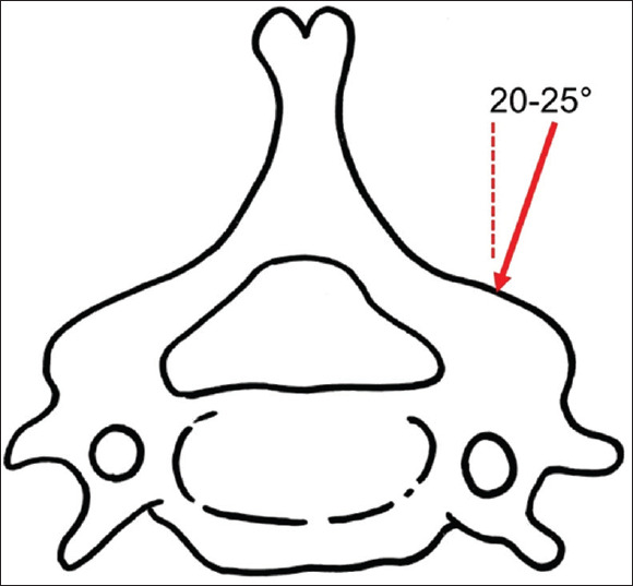 Lateral mass intrapedicular screw fixation: A radiological evaluation of screw pullout strength.