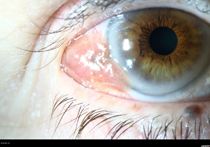 A Case of Conjunctival Melanoma Presenting as a Squamous Cell Carcinoma.
