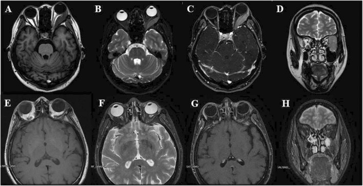 Case report: Orbital myeloid sarcoma: a report of two rare cases and review of the literature.
