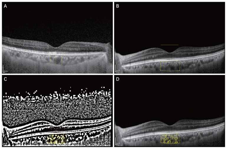 Choroidal Thickening Induced by Pioglitazone in Diabetic Patients.