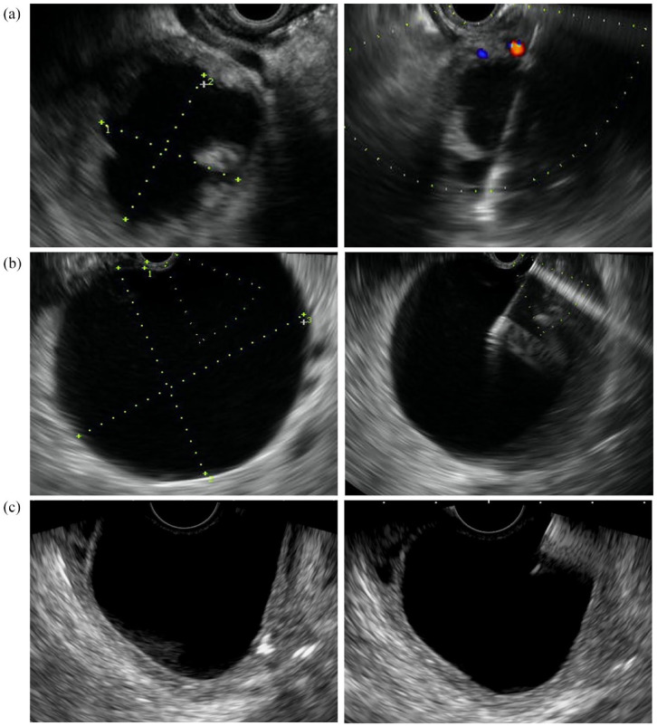 Effectiveness of endoscopic ultrasound-guided simple puncture-aspiration (non-stenting) in the management of abdominal collections.