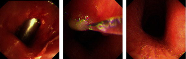 Clinical Analysis of 32 Cases of Subglottic Benign Airway Stenosis Treated With Montgomery T Silicone Stent.