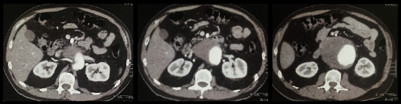Urgent endovascular treatment of juxtarenal aneurysm using a parallel grafts technique.