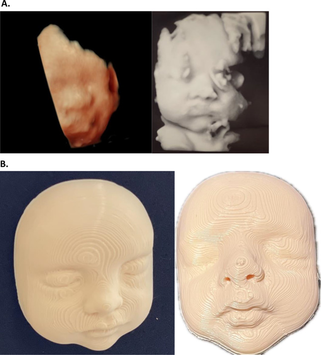 Effects of 3D ultrasonography and 3D printed images on maternal-fetal attachment and its correlation with overall smoking within pregnancy: a pilot study.