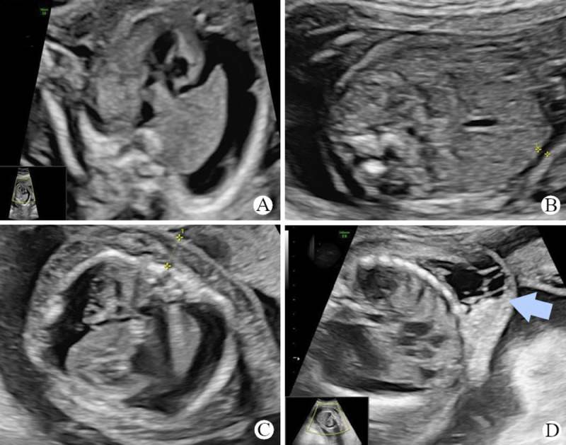 Blended Phenotypes From a <i>SERPINA 11</i> Pathogenic Variant Over Underlying Immune Fetal Hydrops: A Rare Case Report and Literature Review.