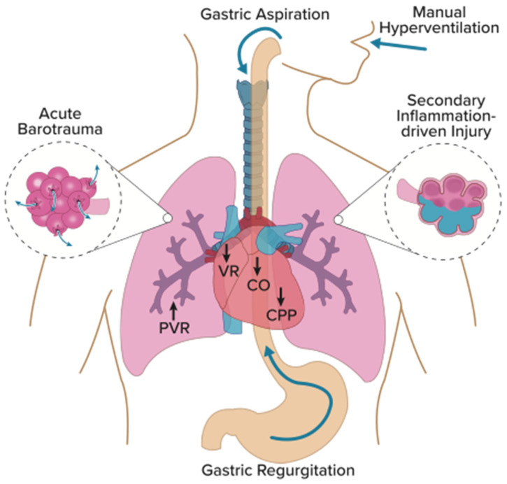 Pathophysiology and Prevention of Manual-Ventilation-Induced Lung Injury (MVILI).