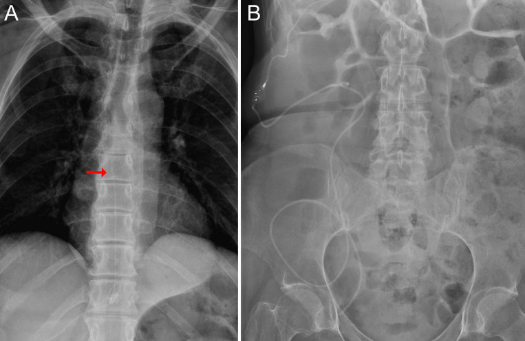 Minimally invasive management of a spinal arachnoid cyst with ultrasound-assisted catheter placement: illustrative case.