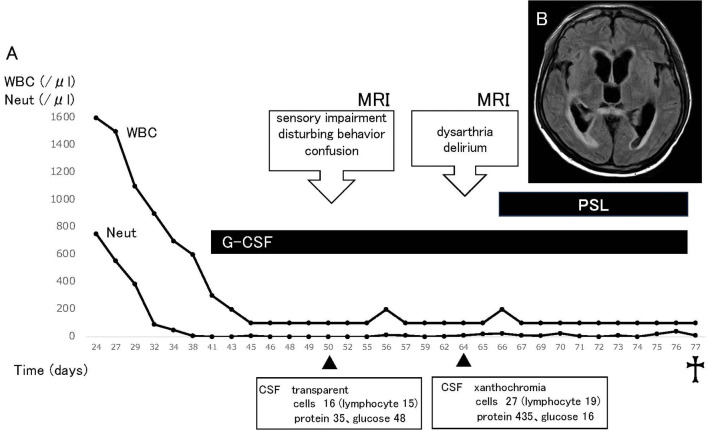 Prolonged severe cytopenia followed by fatal CAR T-cell-mediated encephalitis in a patient with acute lymphoblastic leukemia.