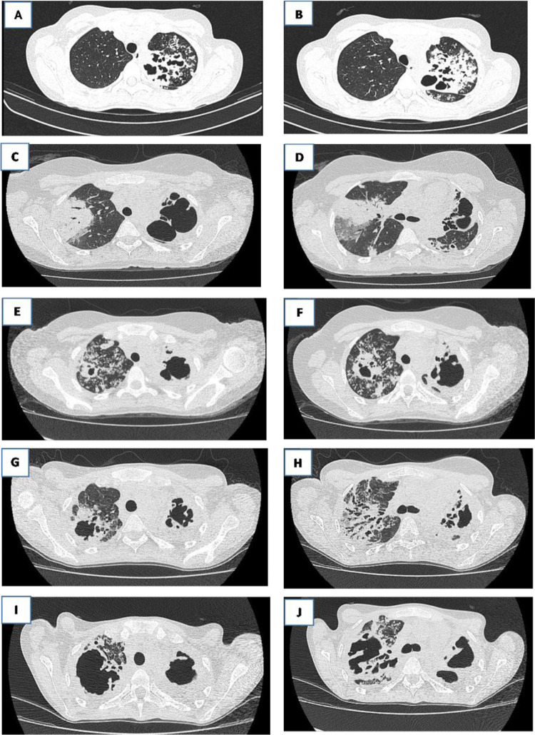 Mitigating adverse outcomes in tuberculosis treatment: analyzing a non-compliance risk assessment strategy in a case report.
