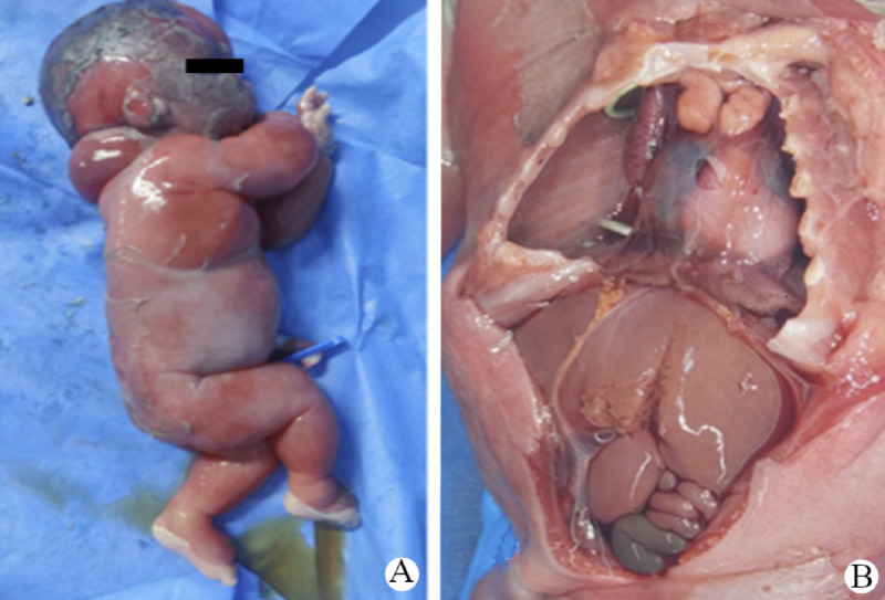 Blended Phenotypes From a <i>SERPINA 11</i> Pathogenic Variant Over Underlying Immune Fetal Hydrops: A Rare Case Report and Literature Review.
