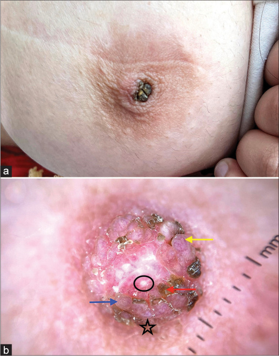 Dermoscopy of nevoid hyperkeratosis of the nipple and/or areola in Fitzpatrick skin type IV.
