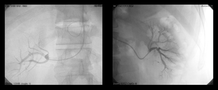 Urgent endovascular treatment of juxtarenal aneurysm using a parallel grafts technique.