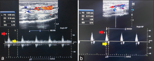 Does the resistive index of the radial artery change after arterial cannulation in patients undergoing abdominal surgery? A prospective observational study.