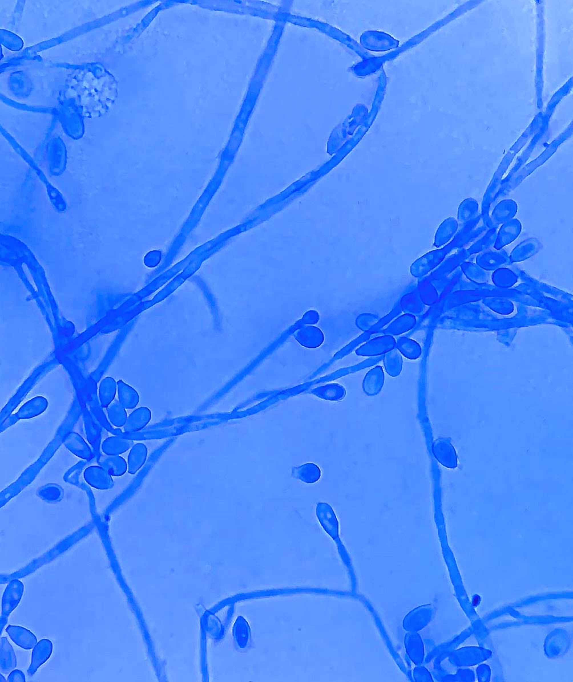 Clinical features and antifungal treatment of invasive Scedosporium boydii infection: report of a case and literature overview.