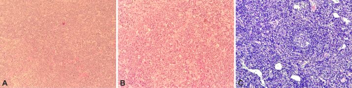 Castleman disease as the great mimicker: the role of complex morpho-pathological evaluation.