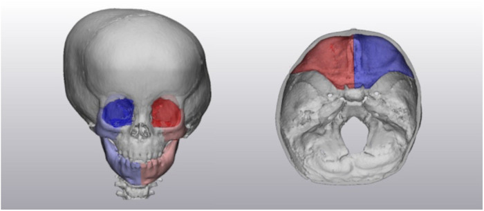 Three-dimensional Analysis of Facial Asymmetry in Unilateral Lambdoid Craniosynostosis.