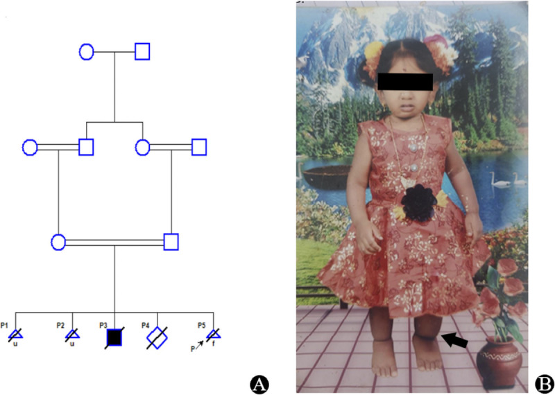 Blended Phenotypes From a <i>SERPINA 11</i> Pathogenic Variant Over Underlying Immune Fetal Hydrops: A Rare Case Report and Literature Review.